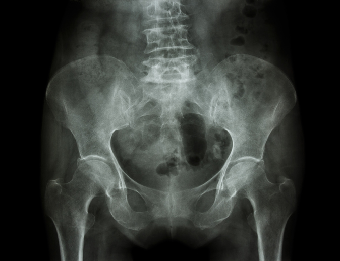 X-ray of pelvis with osteoporosis